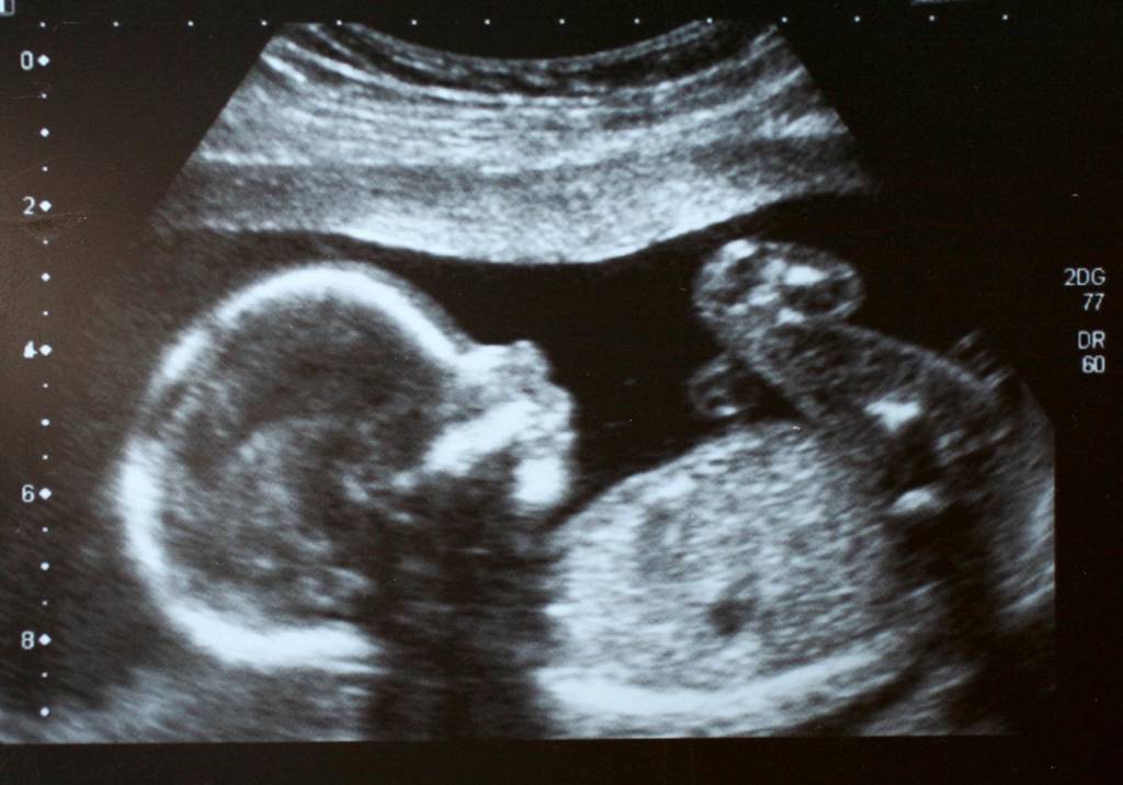 Estudos obtêm novas informações sobre como o zika afeta o bebê na gravidez