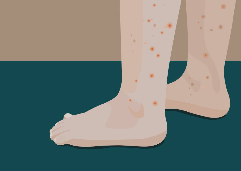 Saiba quando as picadas de inseto são perigosas para as crianças