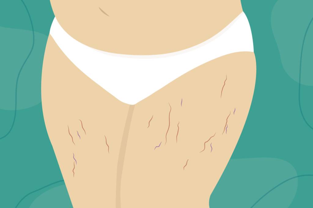 Tudo o que você precisa saber sobre varizes na gestação