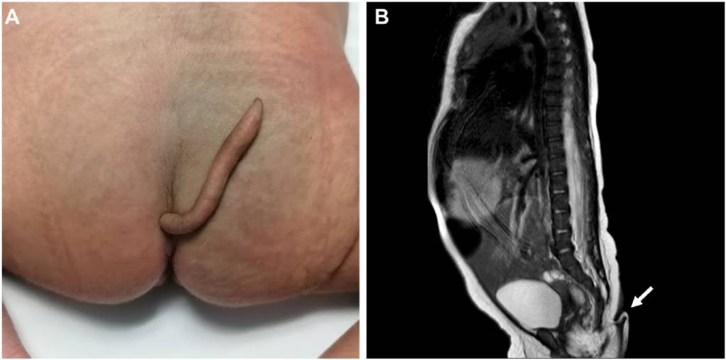 bebe-com-cauda À esquerda, a imagem de um bebê de costas, da região final da coluna e dos glúteos. É possível ver uma fina cauda com cerca de 6 cm de comprimento posicionada para cima, encostada na nádega direita. À esquerda, uma imagem de raio-x do bebê.