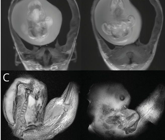 Tomografia gêmeo parasita dentro do crânio 4 imagens de uma tomografia cranial de bebê. É possível observar nas duas imagens de baixo a formação incompleta de um feto, com coluna vertebral.