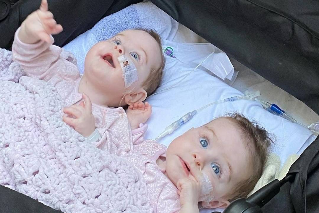 Meninas gêmeas deitadas no carrinho e cobertas. Não dá para ver se elas ainda estão ligadas ou já separadas. São brancas, têm cabelo castanho claro e olhos azuis. Estão sorrindo e olhando para cima.