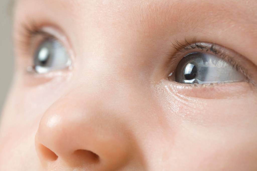 Olhos azuis e grandes de bebê eram, na verdade, sinal de uma doença rara