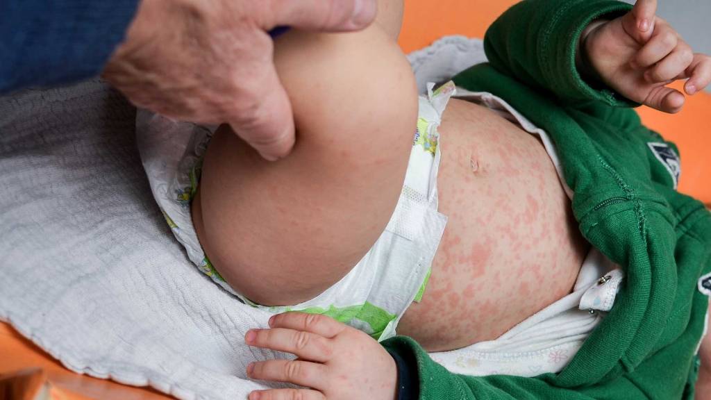 Roséola em bebê: o que é, sintomas e tratamento